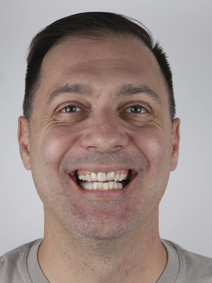 Antes – dente danificado